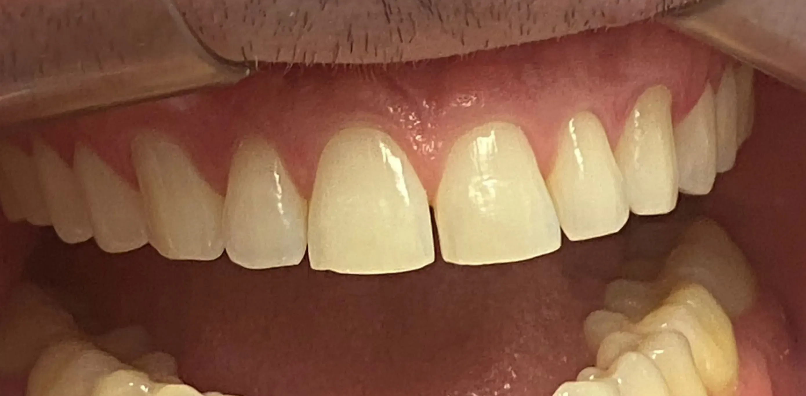 Antes do tratamento odontológico 1