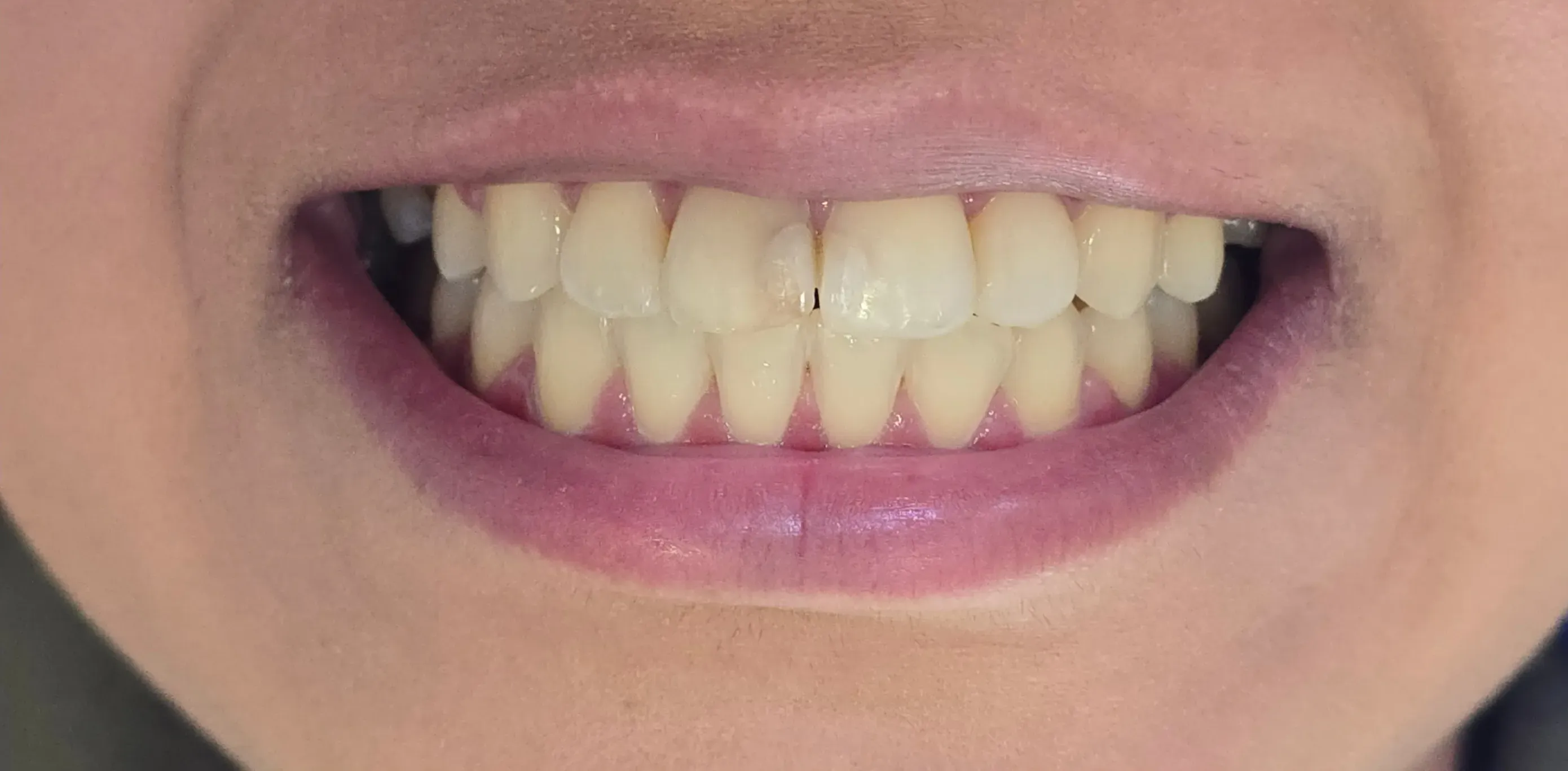 Antes do tratamento odontológico 2