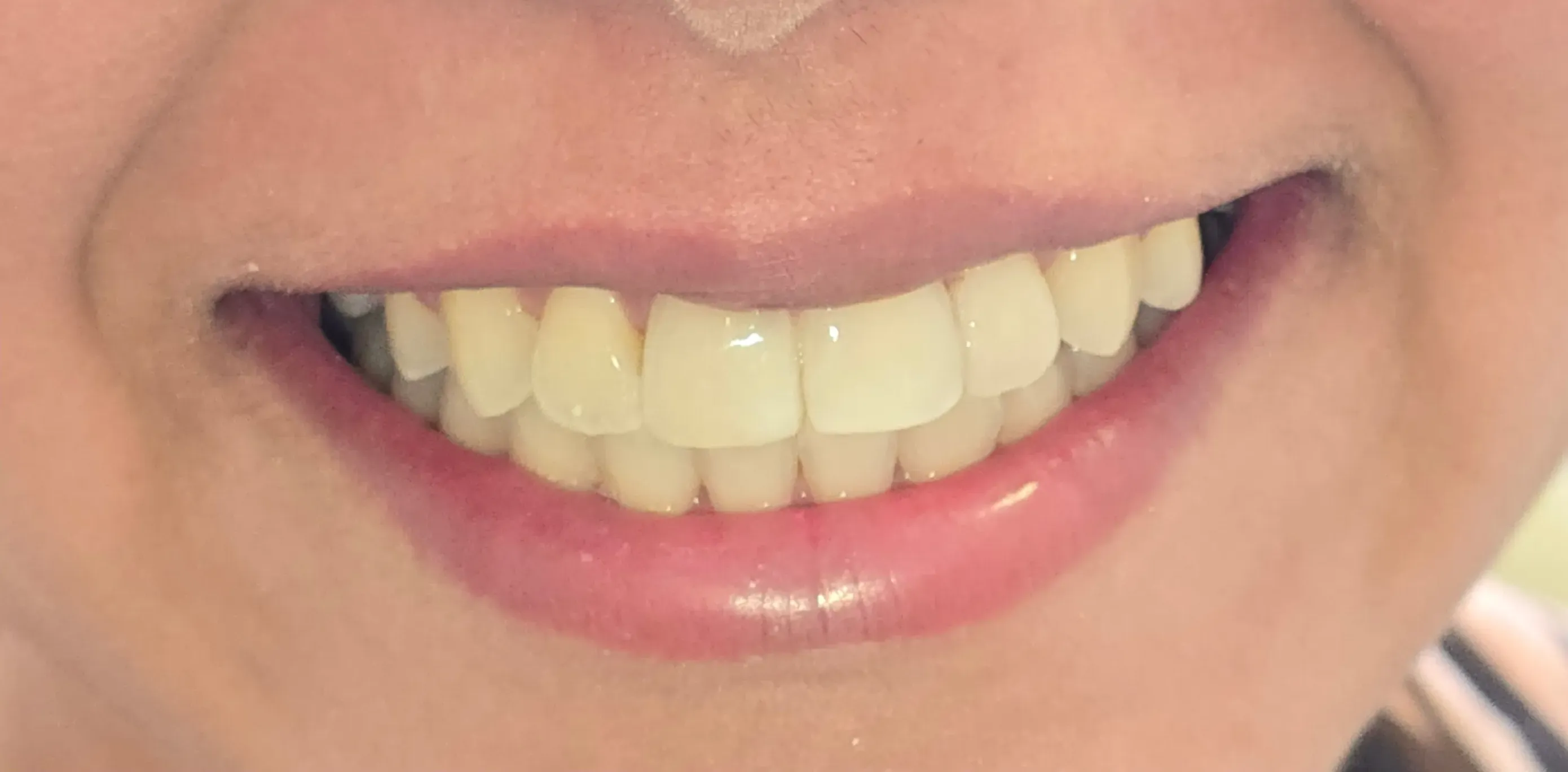 Depois do tratamento odontológico 2