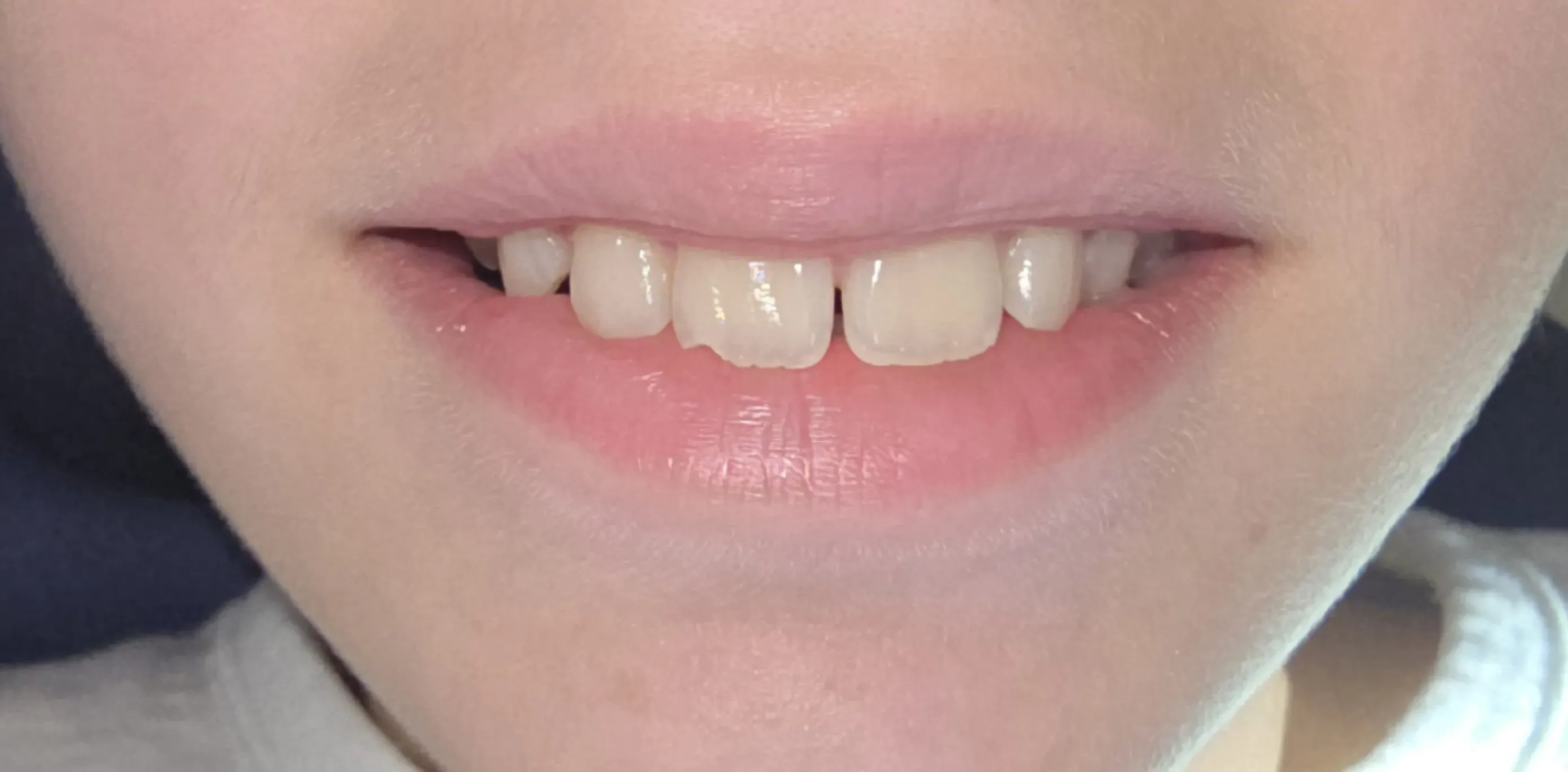 Antes do tratamento odontológico 3
