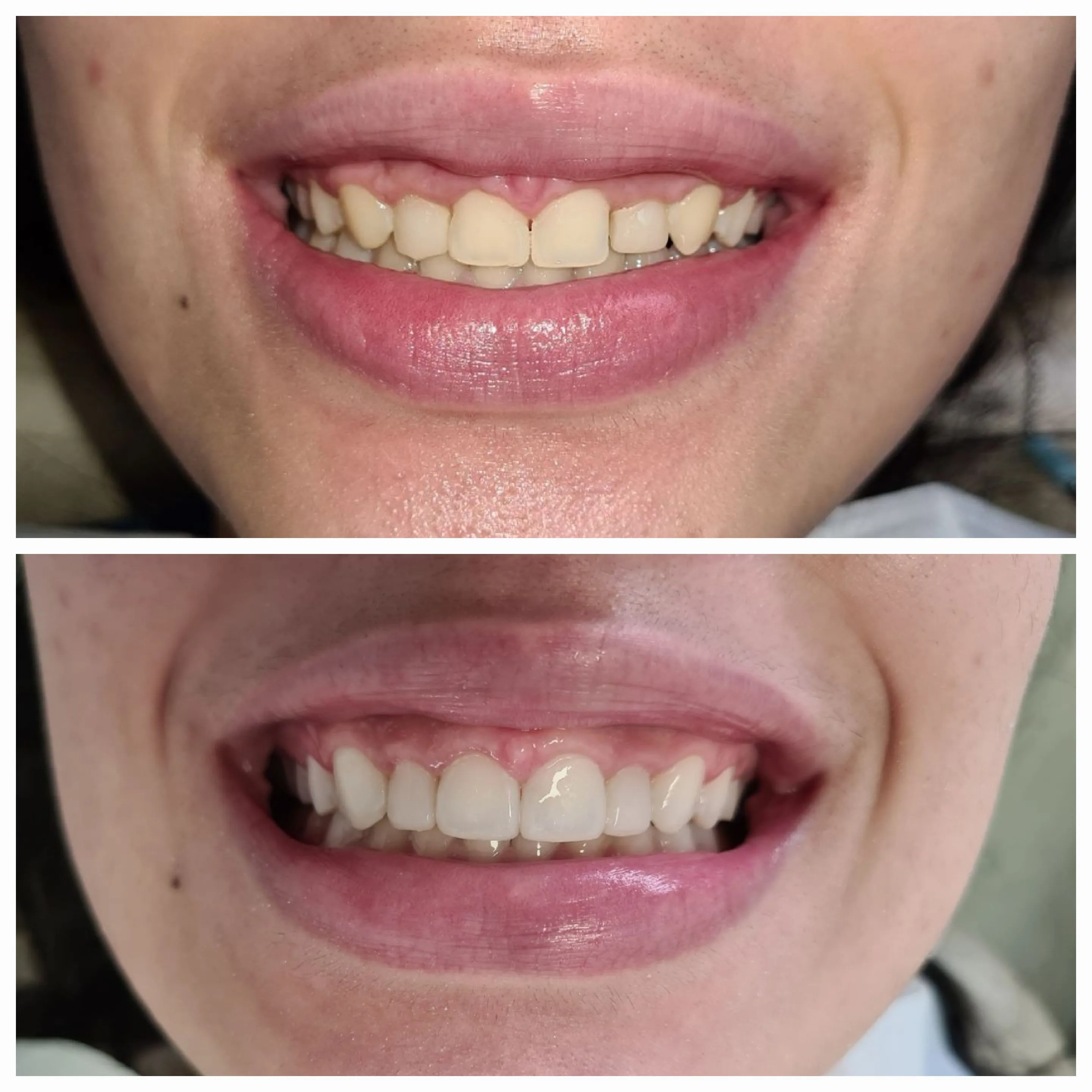 Antes e depois de tratamento odontológico 10