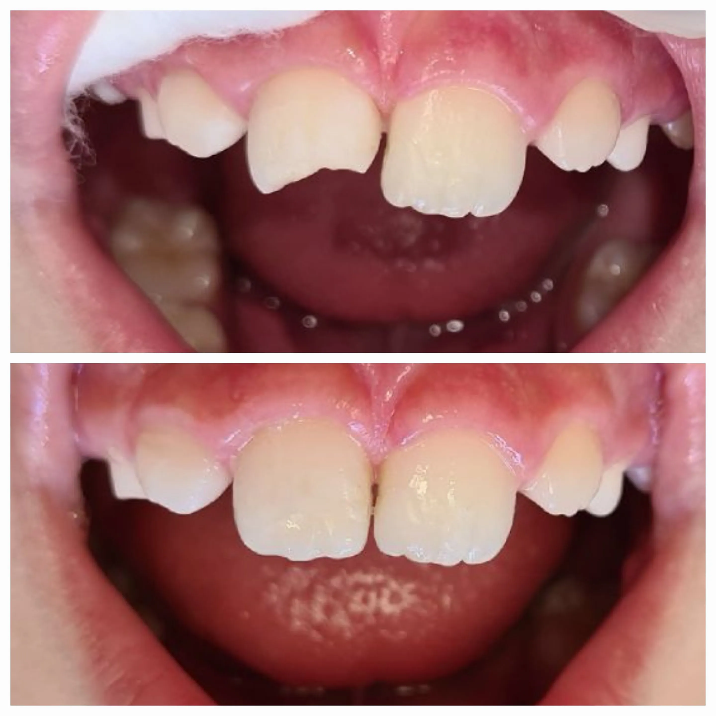 Antes e depois de tratamento odontológico 11
