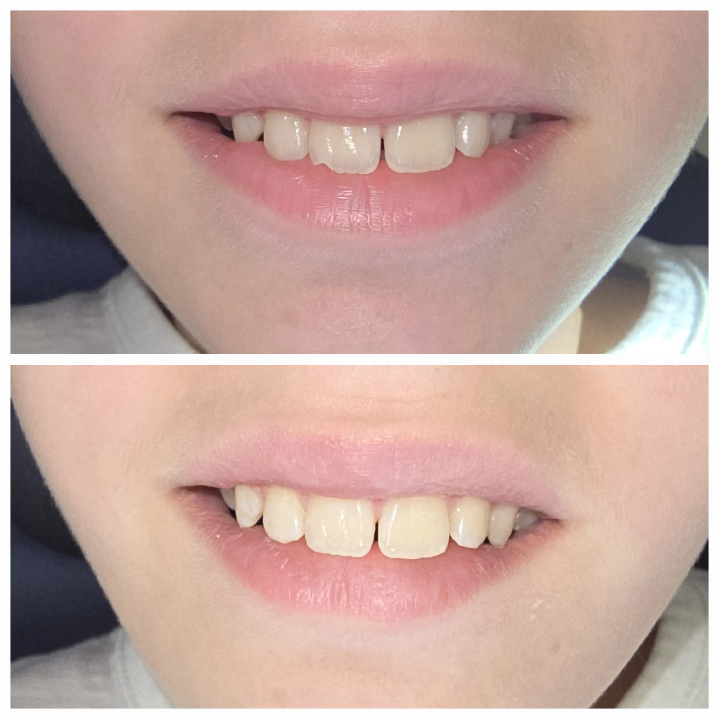 Antes e depois de tratamento odontológico 3