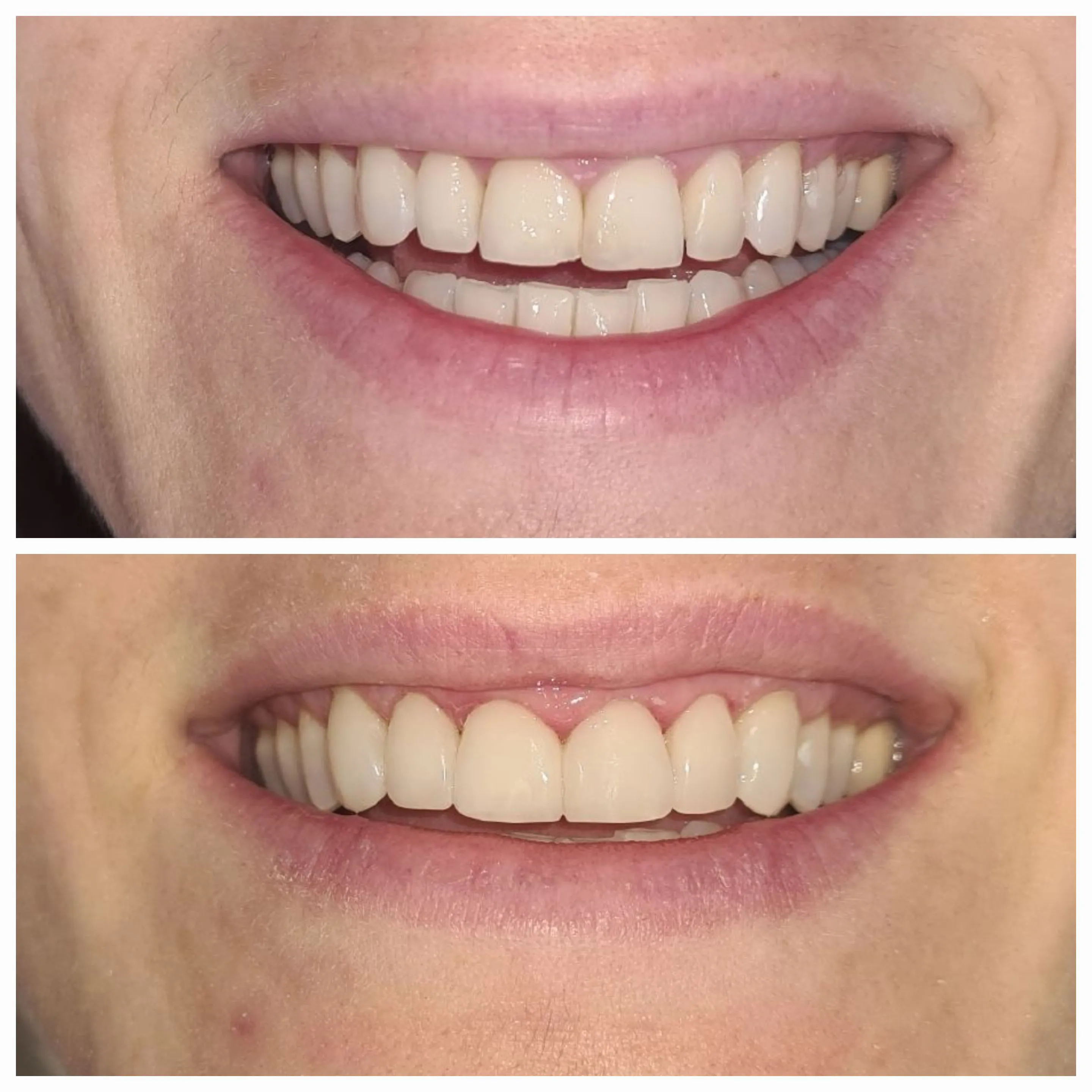 Antes e depois de tratamento odontológico 4