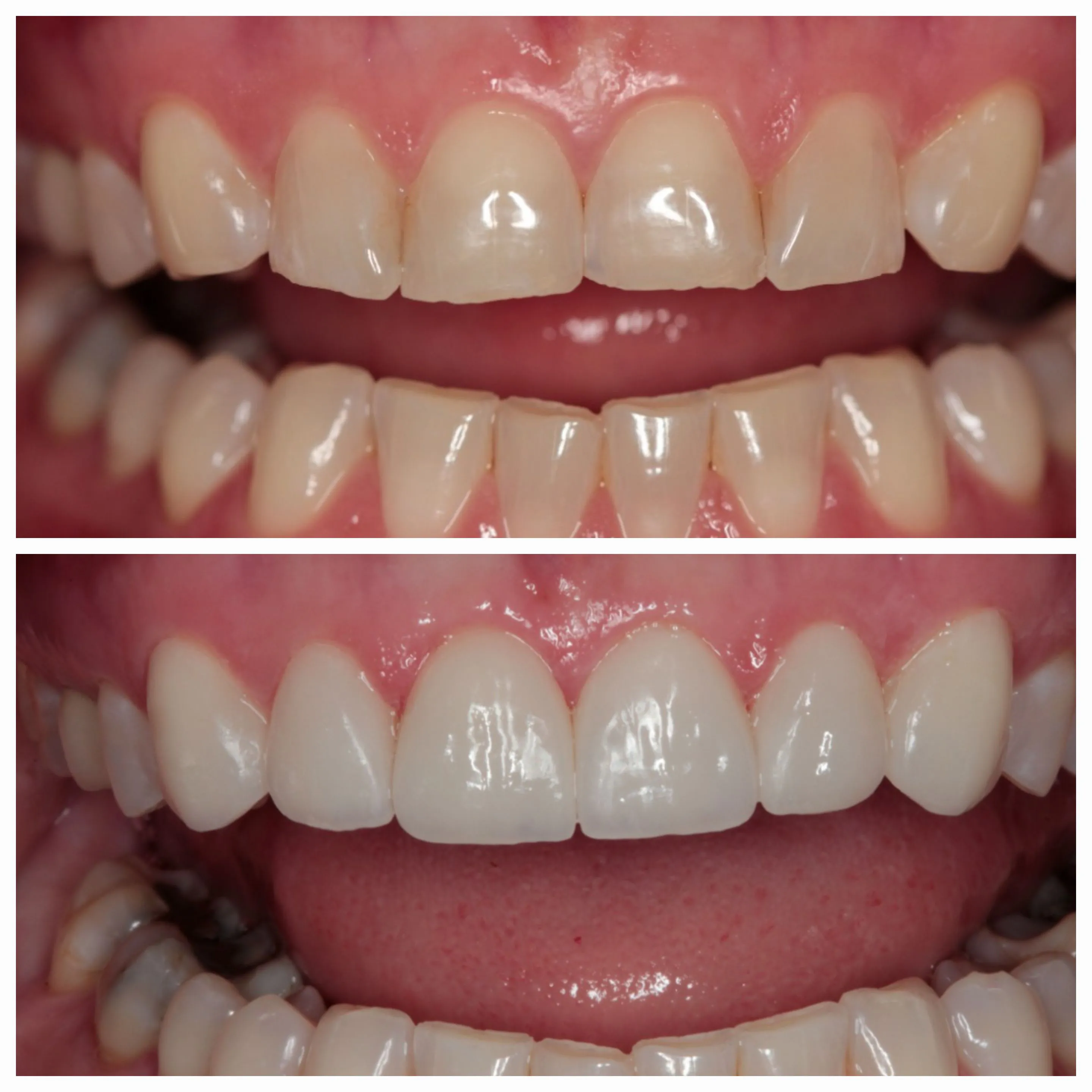 Antes e depois de tratamento odontológico 6